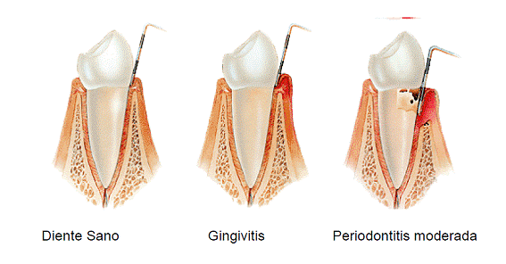 gingivitis-vitoria