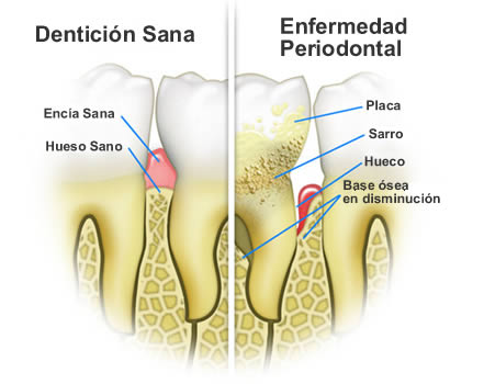 El principio Favor de primera categoría Bolsa periodontal - Clinica dental alaia en vitoria, dentista en Vitoria