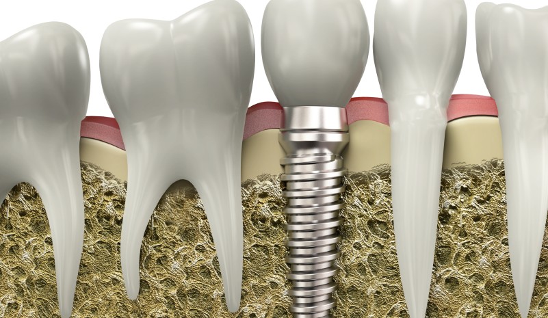 implantes-dentales-alaia